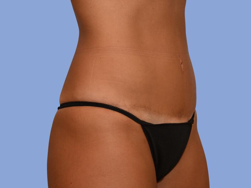 Abdominoplasty before & after photo