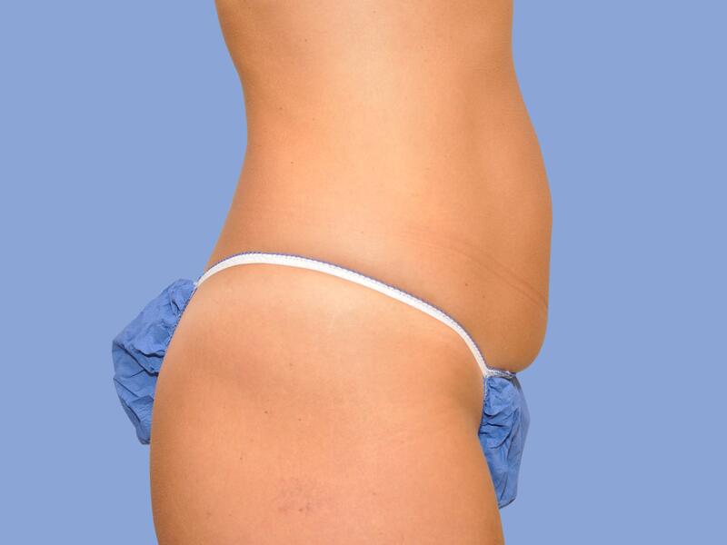 Abdominoplasty before & after photo