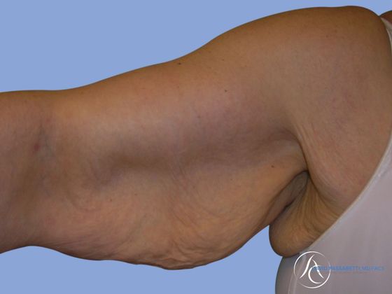 Arm lift before & after photo