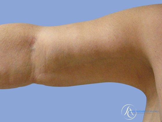 Arm lift before & after photo