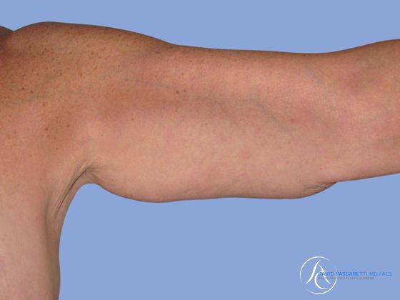 Arm lift before & after photo