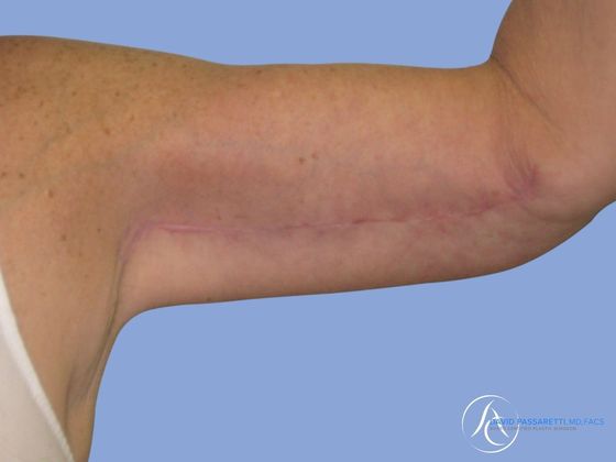 Arm lift before & after photo