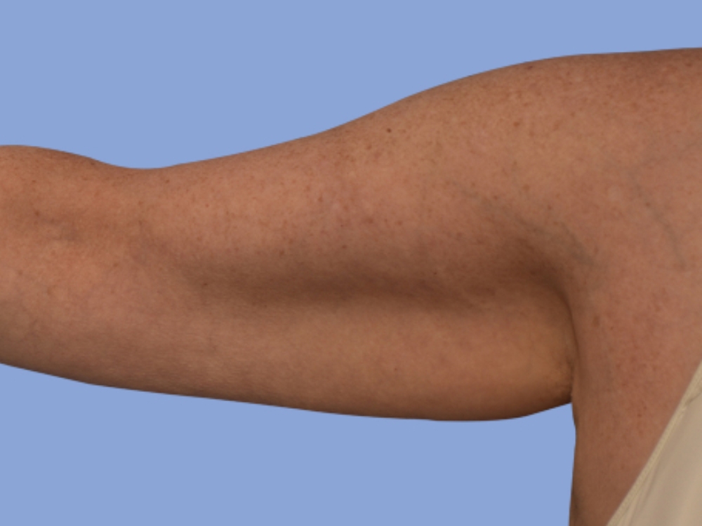 Arm lift before & after photo