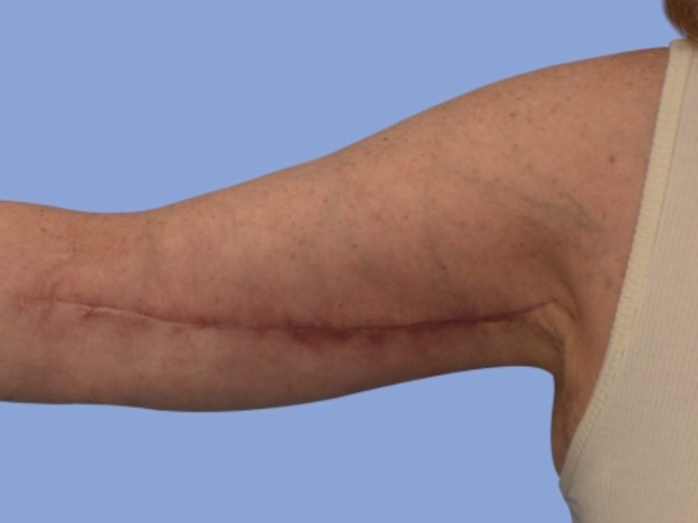 Arm lift before & after photo