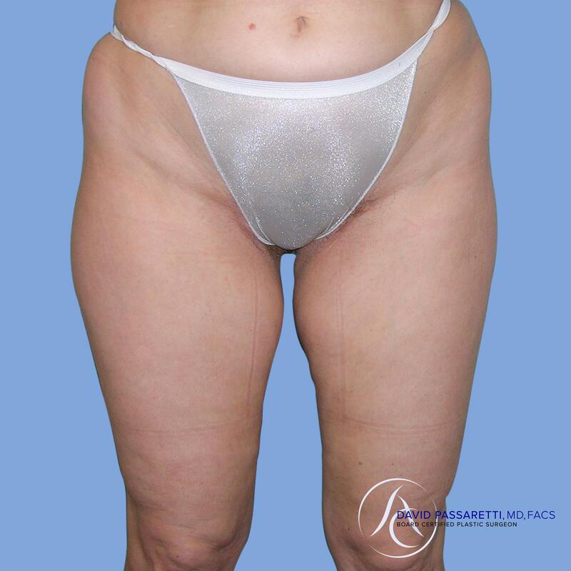 Liposuction before & after photo