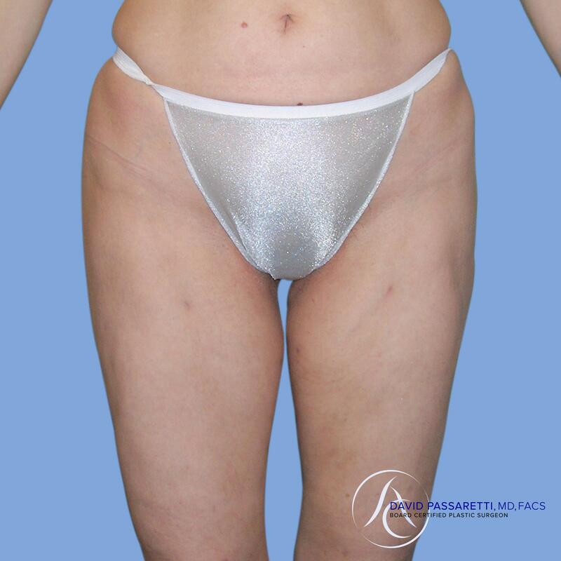 Liposuction before & after photo