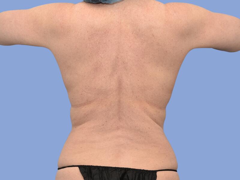 Liposuction before & after photo