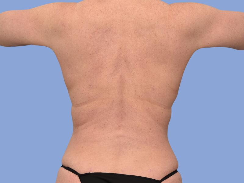 Liposuction before & after photo