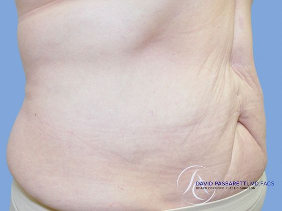 Post bariatric surgery before & after photo
