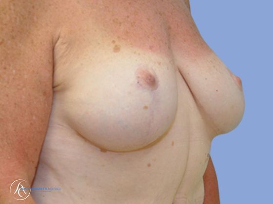 Post bariatric surgery before & after photo