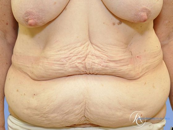 Post bariatric surgery before & after photo