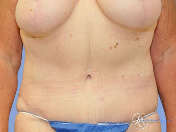 Post bariatric surgery before & after photo