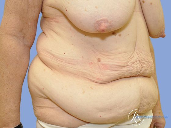 Post bariatric surgery before & after photo