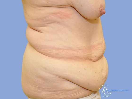 Post bariatric surgery before & after photo