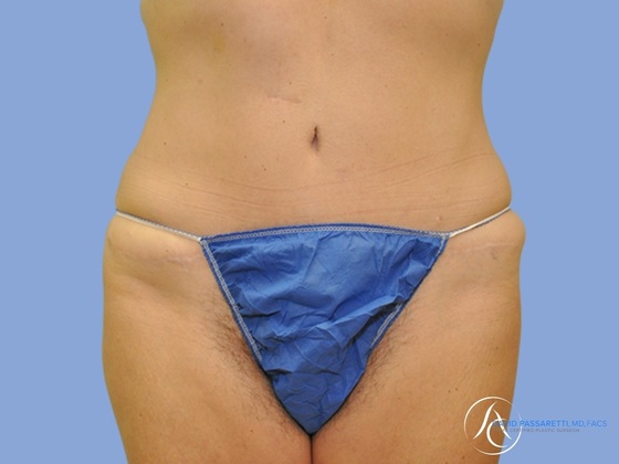 Post bariatric surgery before & after photo