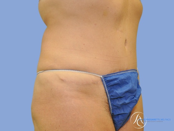 Post bariatric surgery before & after photo