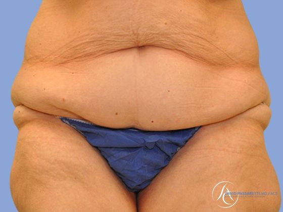 Post bariatric surgery before & after photo