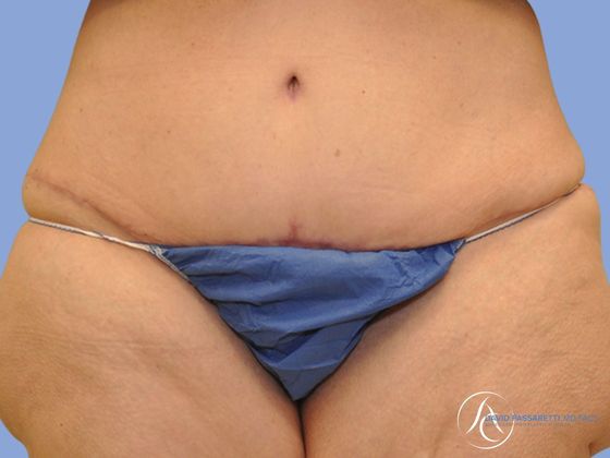 Post bariatric surgery before & after photo