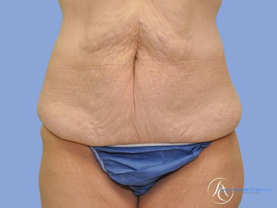 Post bariatric surgery before & after photo