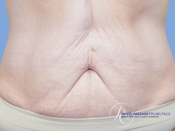 Post weight loss before & after photo