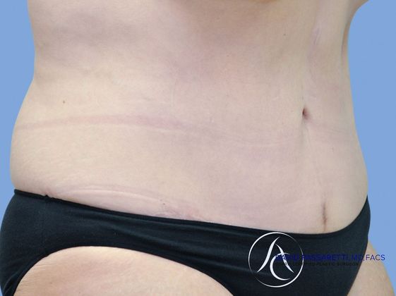 Post weight loss before & after photo