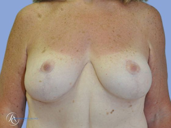 Post weight loss before & after photo