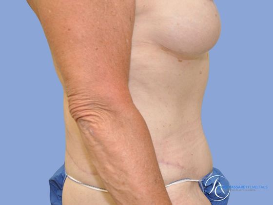Post weight loss before & after photo