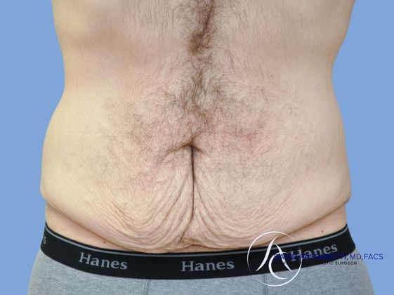 Post weight loss before & after photo