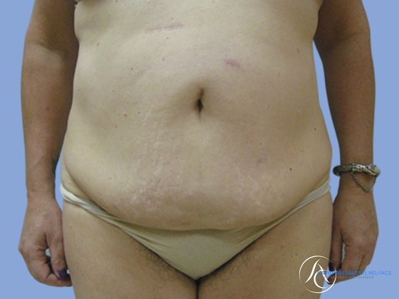 Post weight loss before & after photo