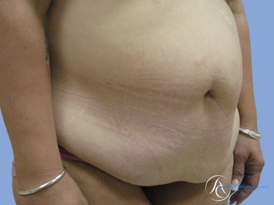 Post weight loss before & after photo