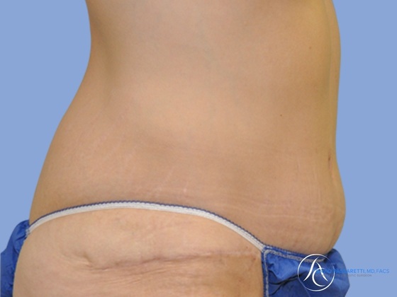 Post weight loss before & after photo