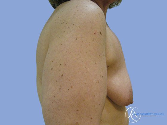 Post weight loss before & after photo