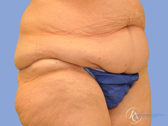 Post weight loss before & after photo
