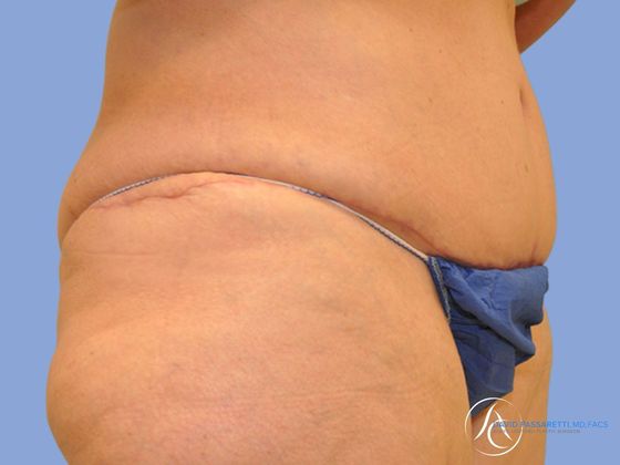 Post weight loss before & after photo