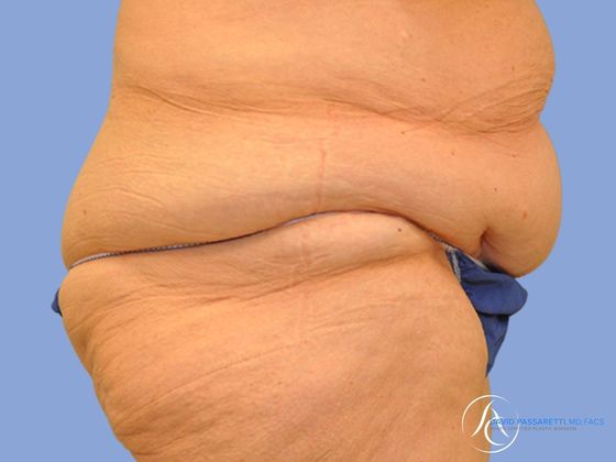 Post weight loss before & after photo