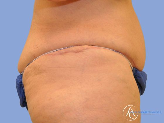 Post weight loss before & after photo