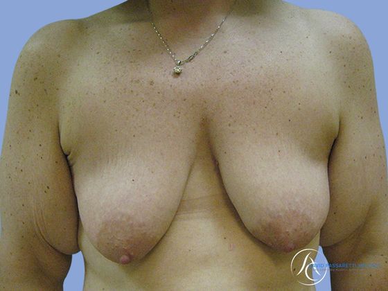 Post weight loss before & after photo