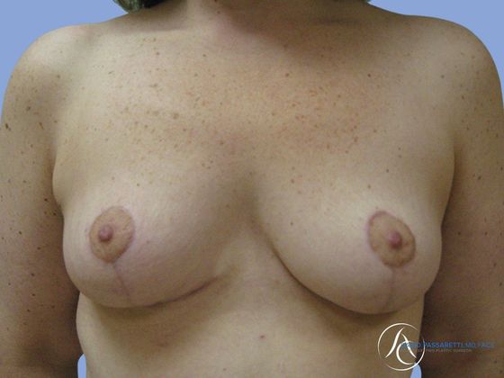Post weight loss before & after photo