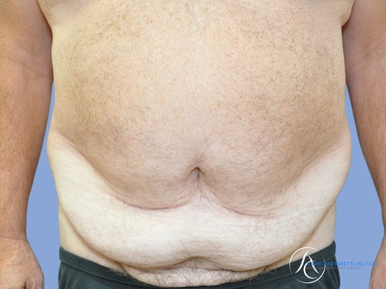 Post weight loss before & after photo