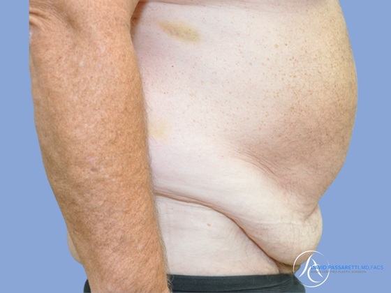 Post weight loss before & after photo