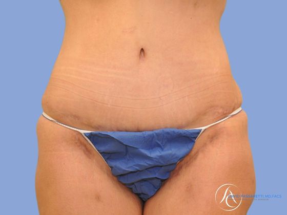 Post weight loss before & after photo