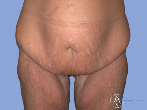 Post weight loss before & after photo