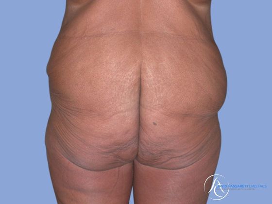 Post weight loss before & after photo