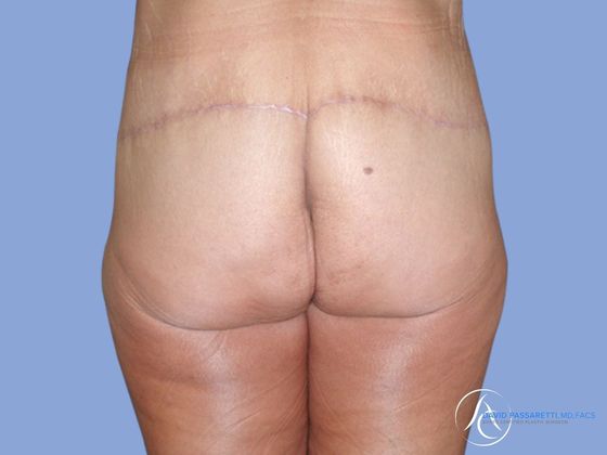 Post weight loss before & after photo