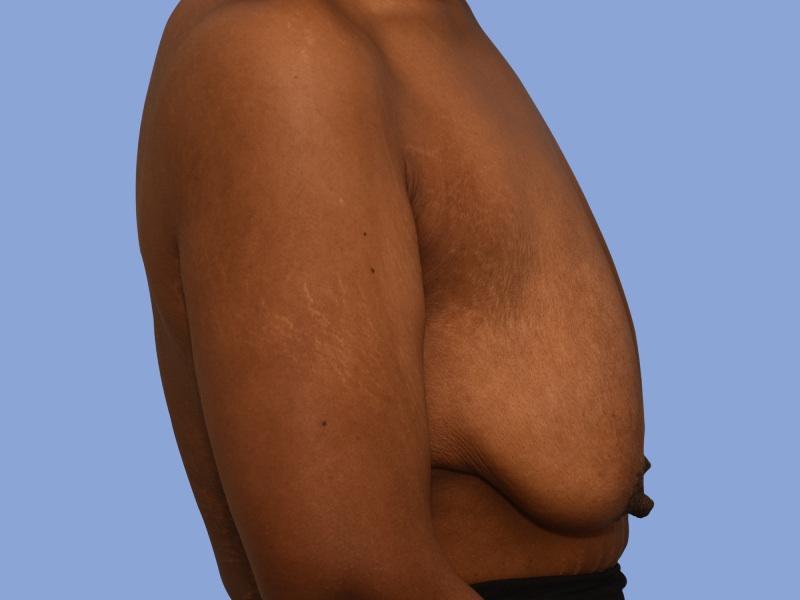 Post weight loss before & after photo