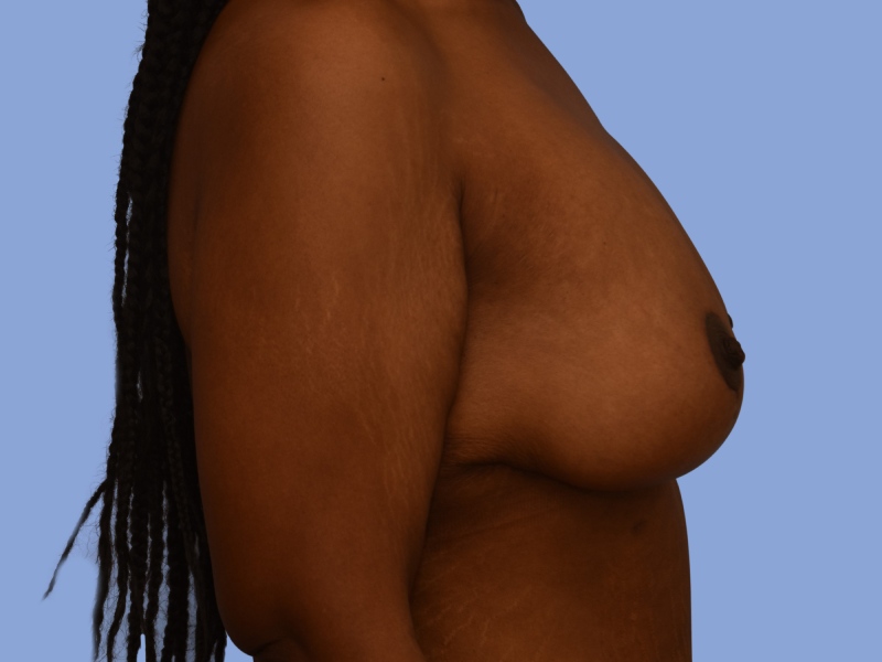 Post weight loss before & after photo