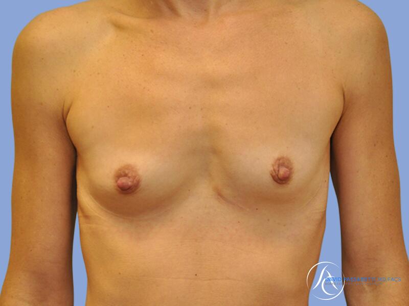 Breast augmentation before & after photo