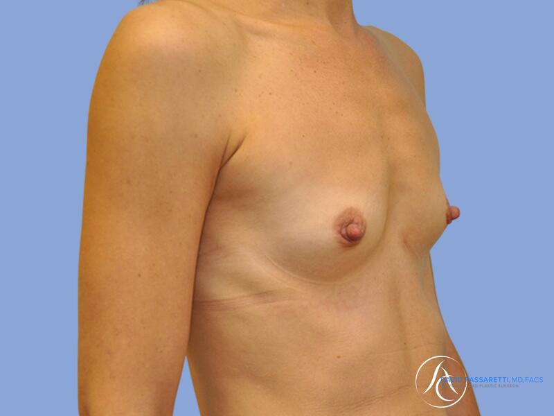 Breast augmentation before & after photo