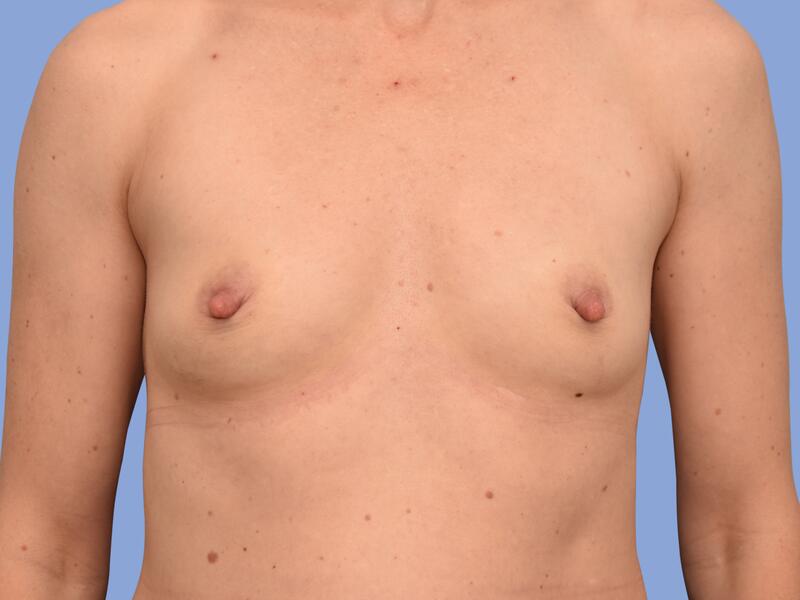 Breast augmentation before & after photo