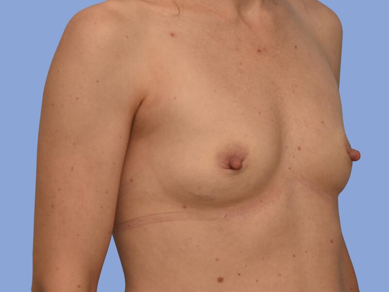 Breast augmentation before & after photo